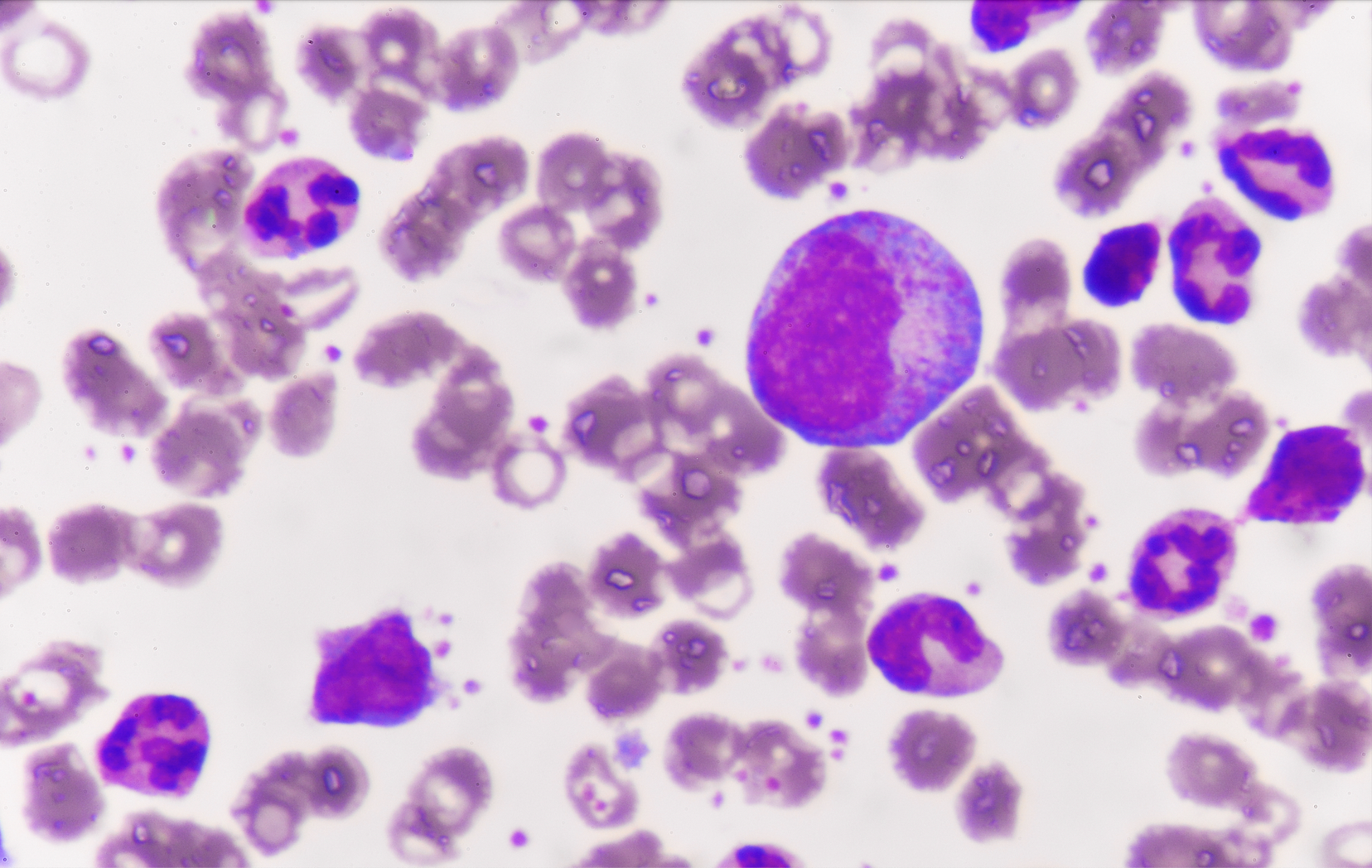 Leukemia